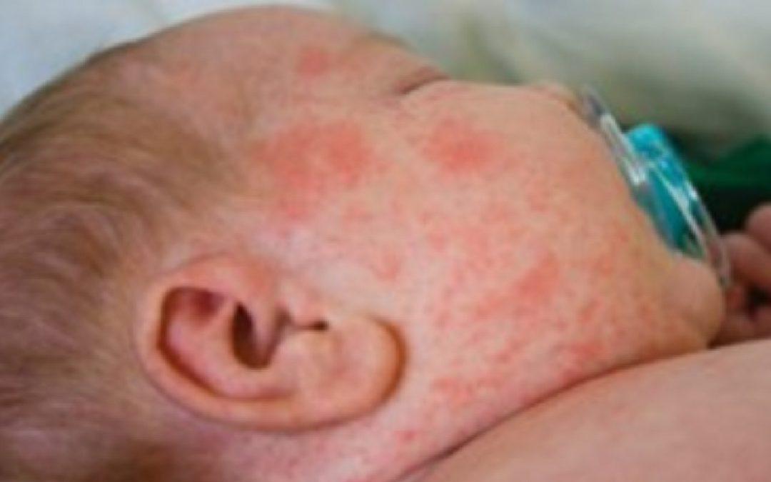 Na području FBiH registrirano 7456 slučajeva morbila